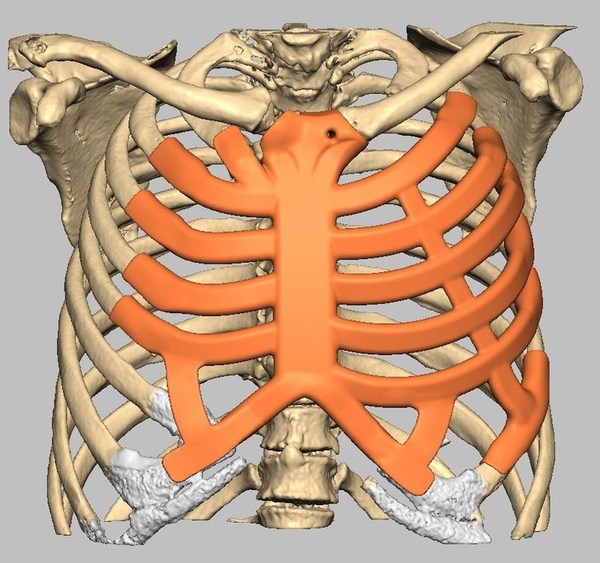 Incredible World First Ribcage Implant Becomes 'alive'